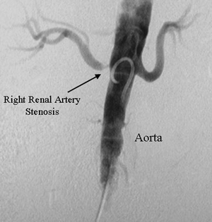 right renal artery stenosis - aorta