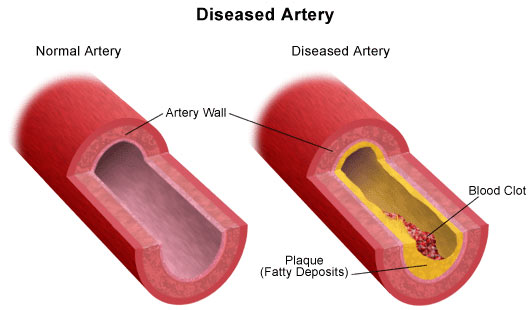 diseased artery