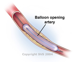 Balloon opening artery