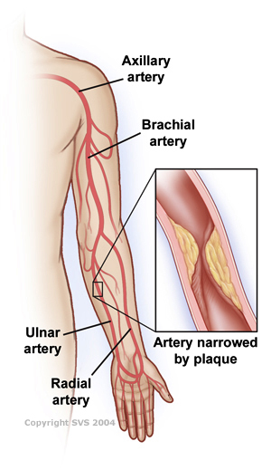 Arm artery disease