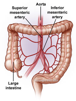 Illiac Artery Narrowed
