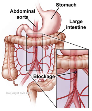 Illiac Artery Narrowed