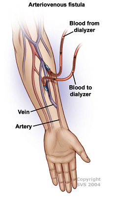 arteriouvenous fistula