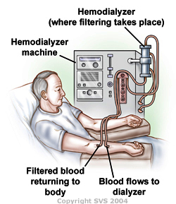 hemodialyzer