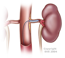 stent in kidney