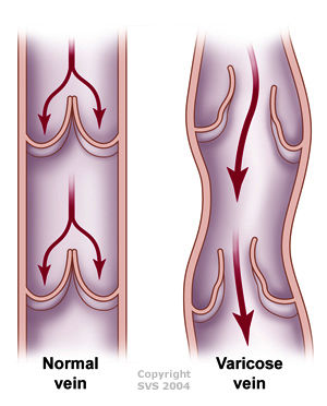normal vs varicose veins