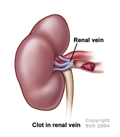 clot in real vein