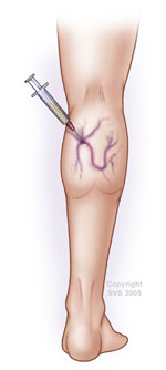 sclerotherapy for varicose