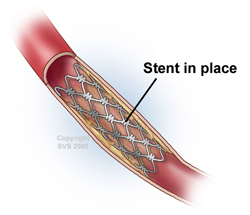 stent in place